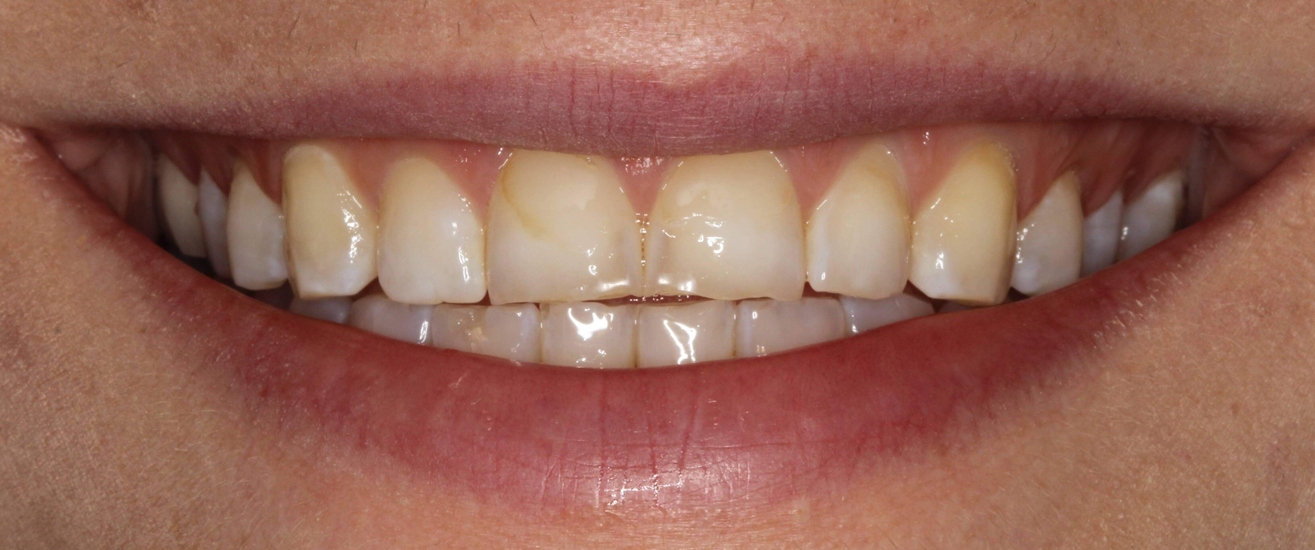 Beautiful Veneers NYC