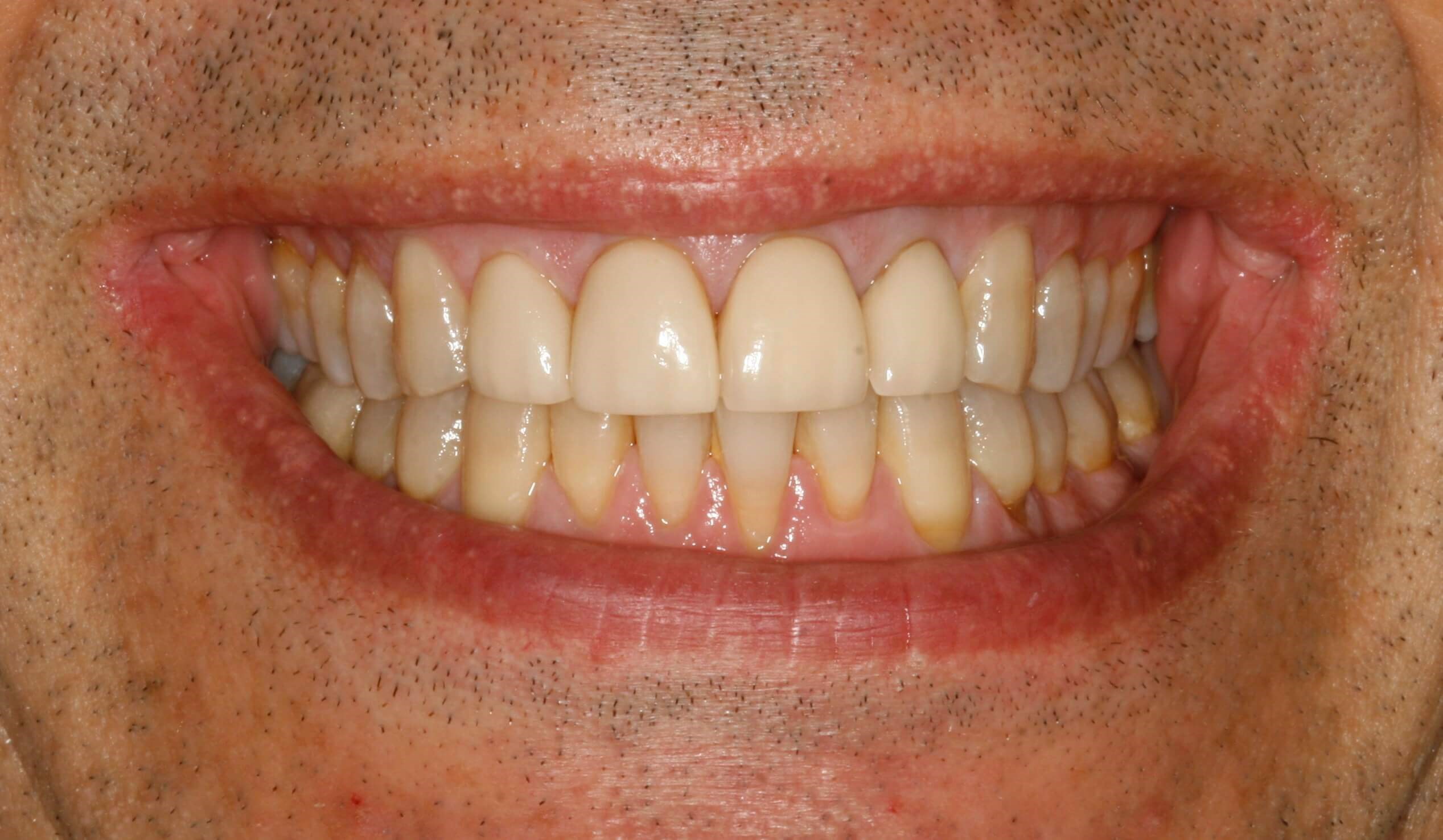 Porcelain Veneer Replacement at SmilesNY