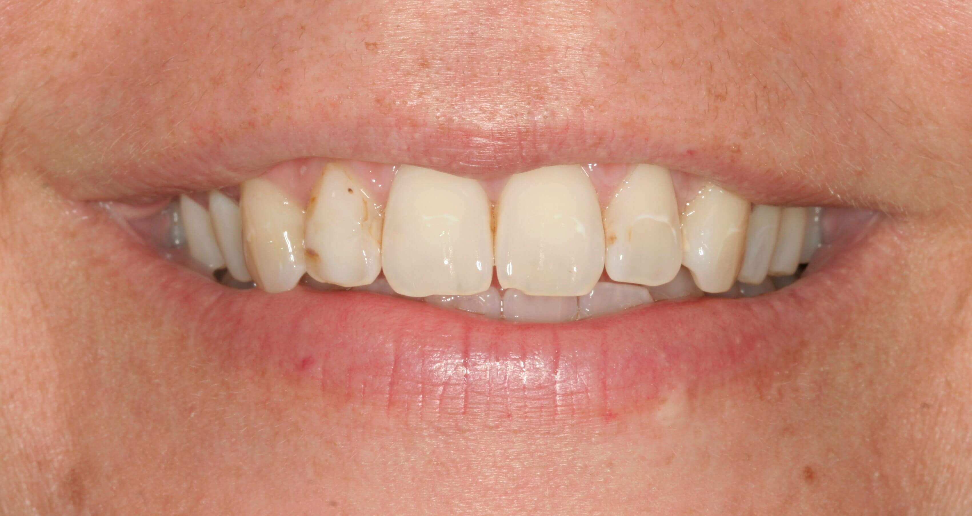 NYC Patient has Beautiful Veneer Procedure at SmilesNY