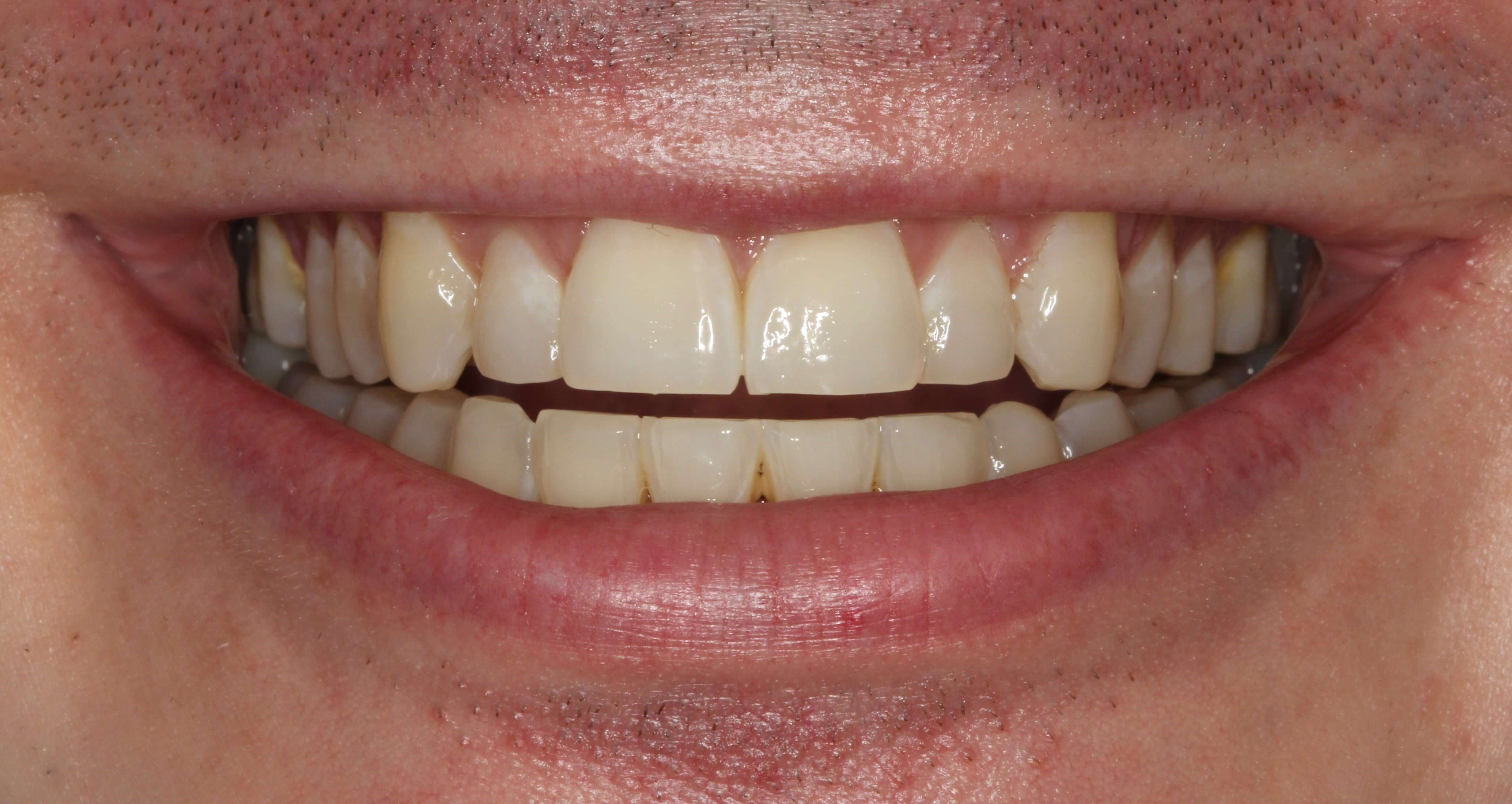 Another Amazing Veneer case at SmilesNY