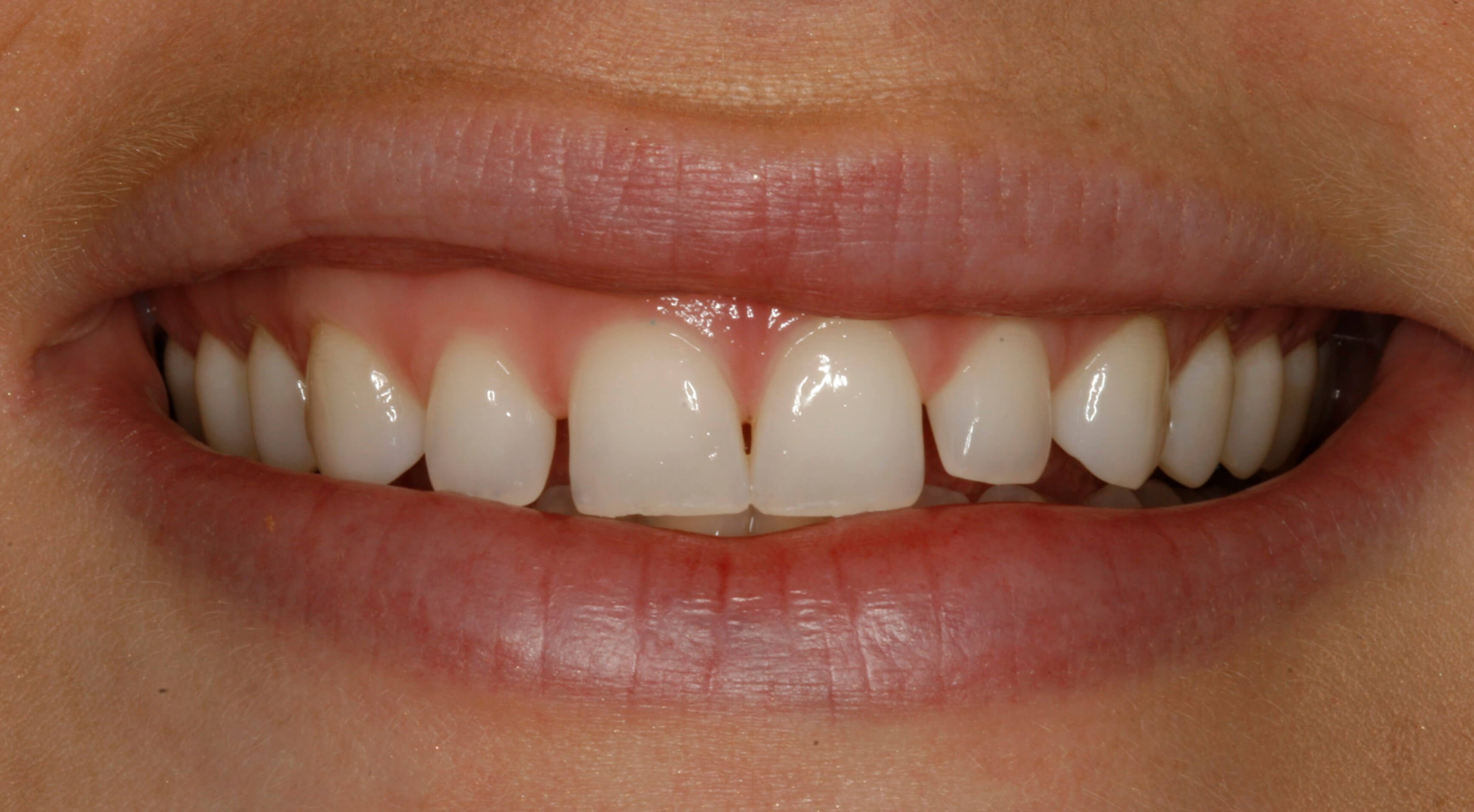 Beautiful Smile With Porcelain Veneers At Smilesny