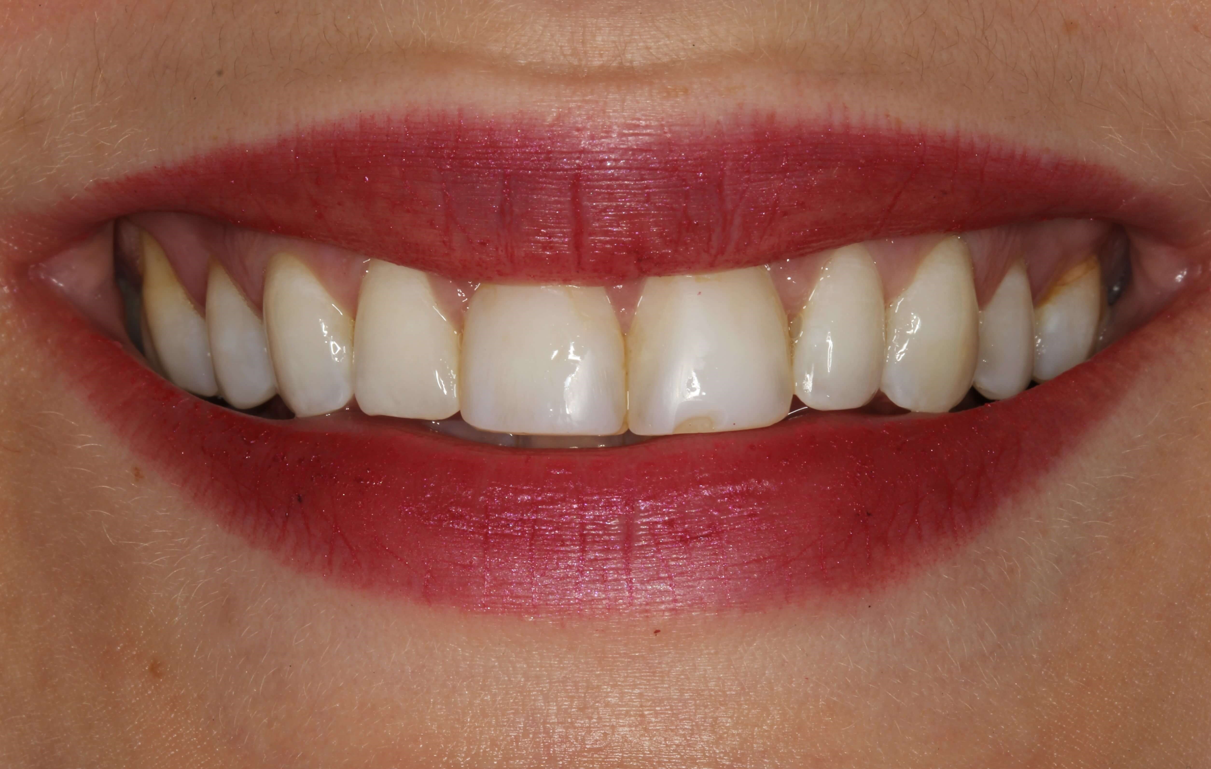 Porcelain Veneers at SmilesNY in New York City