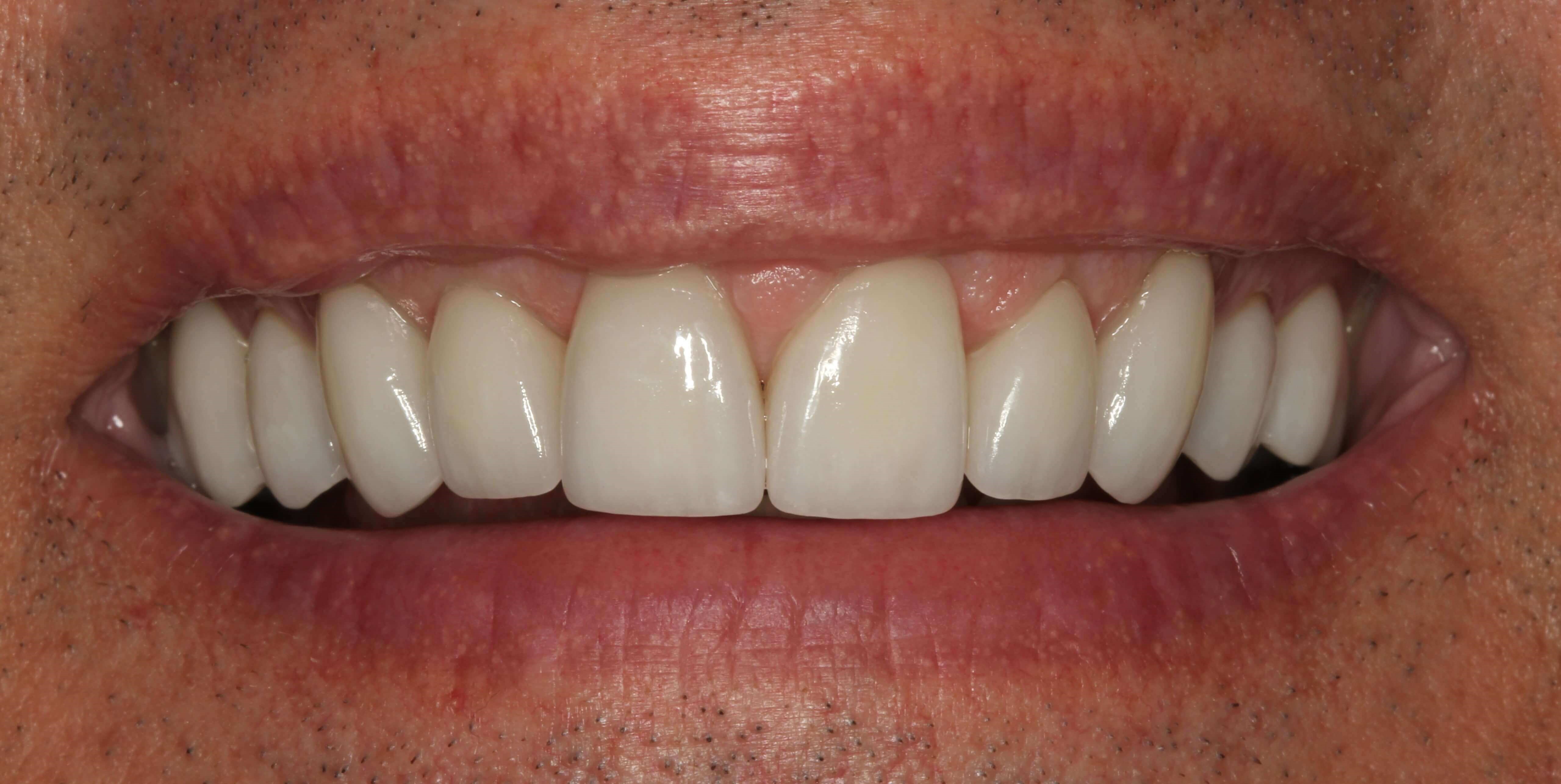 Old Bonding Replaced with Porcelain Veneers in New York City
